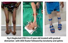 Orthopaedics Shoes